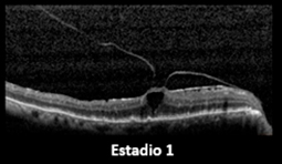 Estado 1